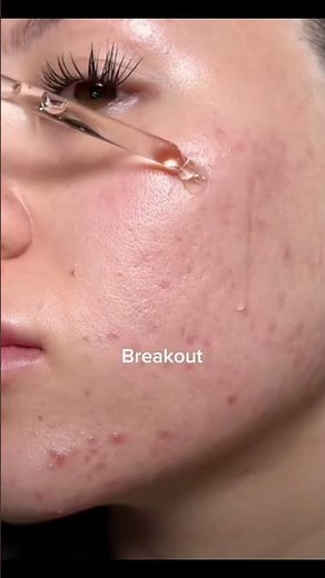 SKIN1004 Madagascar Centella Ampoule for Breakout-Prone Skin ✨