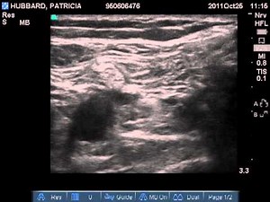 Popliteal Ultrasound Imaging