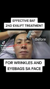 BEFORE AND AFTER: EFFECTIVE BA? My 2nd Session of #Exilis or #Exilift na #Facelift for #Wrinkles and #Eyebags sa Face and Neck. Thank you La Trinidad Branch- Rhodagenix Aesthetic and Wellness Center and Rhodagenix aesthetic and wellness center ENERGY OIL AVAILABLE HERE: https://shope.ee/406l26BKfw #Rhodagenix La Trinidad Location: Farmer's Trading Cender Puguis, La Trinidad, Benguet Gusto ko na talaga ang effect ng #Exilis Face Lift Treatment and #Massage with Energy Oil #fyp #fypシ #foryou #aest