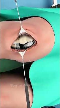 How Knee Replacement Surgery Is Performed? (3D Animation)#kneereplacement #kneereplacementrecovery