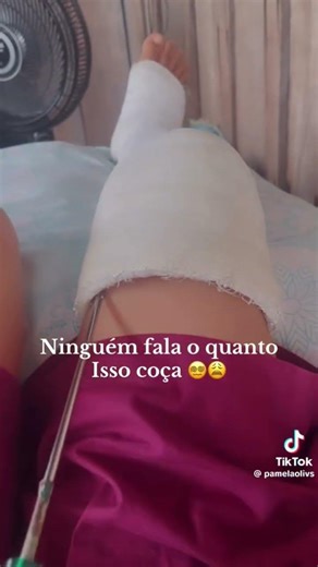 LONG LEG CAST WOMAN MUJER ENYESADA #escayola #cast