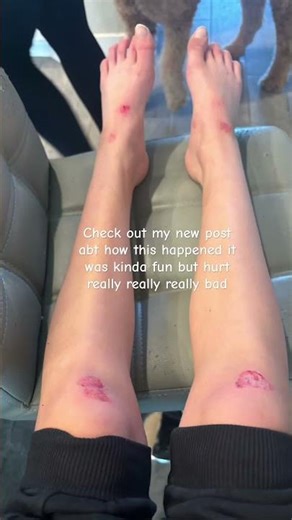 Ummm #sorry #hurt #prayer #fell #injured #blood #post #recent #golfcarts