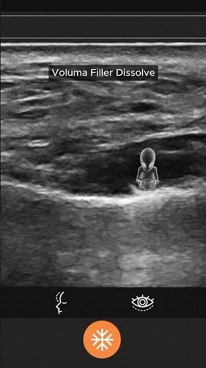 Ultrasound-Guided Filler Dissolve (Voluma)| Dr. Jalalabadi