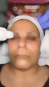 Dr. Nüket Eroğlu, MD. on Instagram: "Ultherapy is a non-surgical face lift. It provides the removal of deep scars on your skin due to time-dependent bad habits, environmental factors and genetic factors. In addition to reviving the face, neck and décolleté areas that are worn by the sun’s rays, they tightens the sagging on your skin, helps with wrinkles and double chin, open eyebrow-eye distance and tightens up your face. Each region is applied separately, completely painless. ❤👍🏻😇🙏🏻💕🌸�