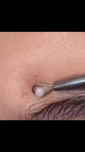 Derma_mentor on Instagram: "Pimple extraction or PEARL extraction🤪 🥚 . . #acne #derma #skin #skincare #pimple #pimplepopper #blackheads"
