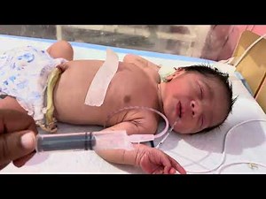 Newborn Baby NG Tube Insertion & Stomach Washing Procedure Explained
