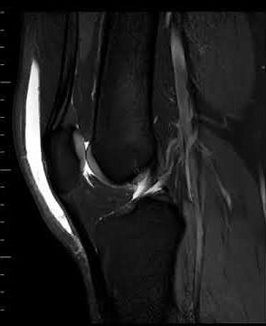 Prepatellar bursitis
