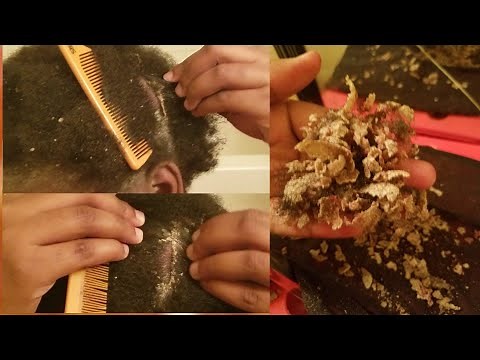 HAND FULL OF HUGE FLAKES!!!! //EXTREME DANDRUFF//SCRATCHING MY SCALP//PSORIASIS FlAKES