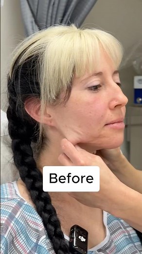 Endoscopic Deep Plane Facelift Transformation - 6 Week Update #facelift