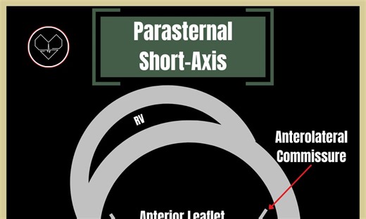 Mitral Valve: Beyond the Basics