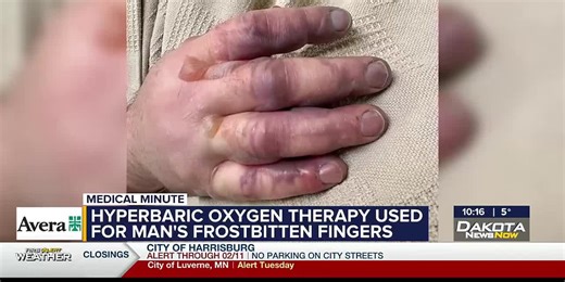 Avera Medical Minute: Hyperbaric oxygen therapy used for man’s frostbitten fingers