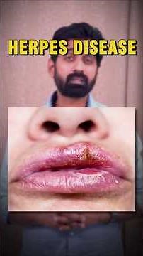 H for Herpes | Ayurvedic Tips & Natural Management | A to Z Ayurveda Series #ayurveda #ayurvedic