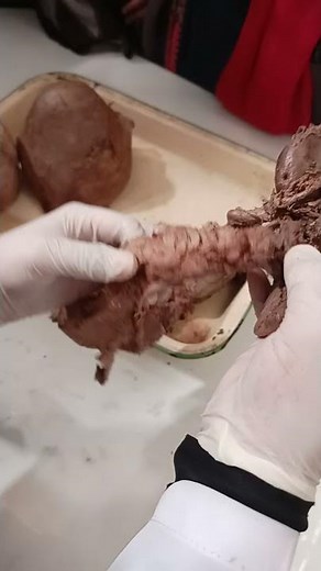 Pancreas Dissection