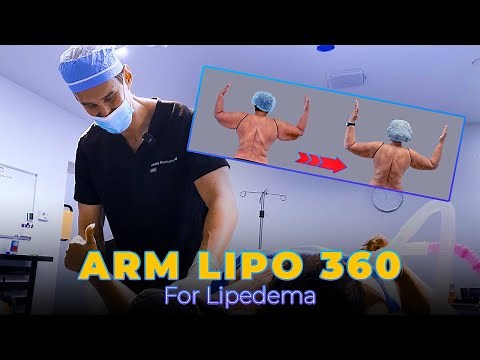Awake Arm Lipo 360 For Lipedema