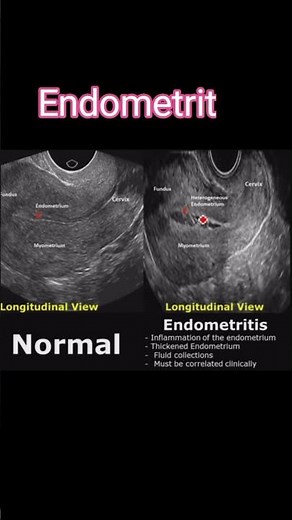 Normal uterus vs endometritis #medical $#medicalimaging #pregnancyjourney #baby #shorts