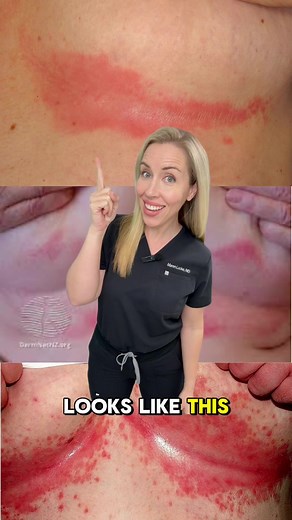 How to Treat Intertrigo: Effective Drugstore Remedies