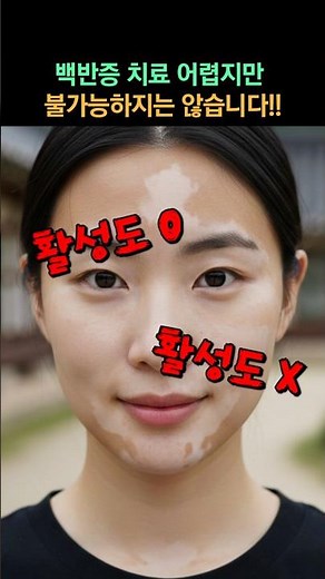 백반증 치료 정확하게 알고 치료를 해야합니다!!#엑시머레이저 #백반증 #백반증진단