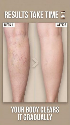 The Real Reason Your Spider Veins Returned