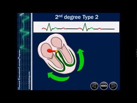 Heart block The best online ECG training available