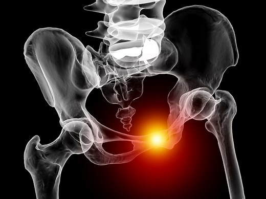 Pubalgie : symptômes, la soigner, c'est quoi ?