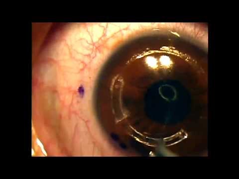 Intacs for keratoconus using the intralase femtosecond laser