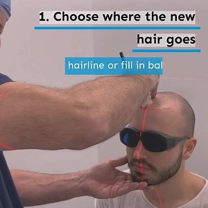 1K views | 퐁퐚퐥퐝퐢퐧퐠 퐢퐧 퐒퐚퐧 퐀퐧퐭퐨퐧퐢퐨? 퐖퐞 퐜퐚퐧 퐟퐢퐱 퐢퐭.” Hair restoration changes lives. We helped 40,000+ patients get their hair and confidence back. Why Advanced Hair? ✅ Simple 1-day treatment ✅ Uses your real hair ✅ Permanent results | Advanced Hair Restoration | Facebook