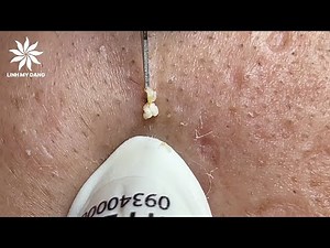 Relaxing Acne Treatment #42 | Hidden Acnes