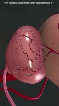 Prostate Artery Embolization 3D Animation#prostat #artery #embolization #shrink #supply #blood