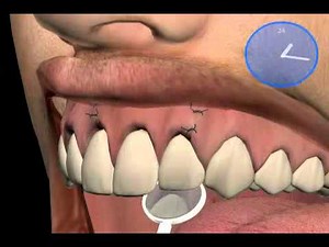 Root Tip Resection in Dentistry with orthograde Filling