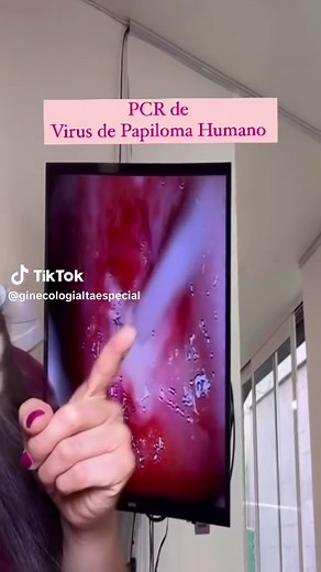Prueba PCR para detectar VPH: Todo lo que necesitas saber