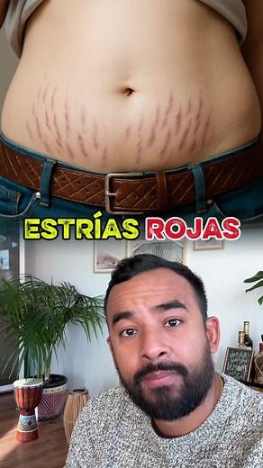 Tengan cuidado con este tipo de estrías