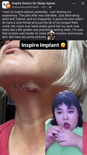 Cpap Reviews on Instagram: "Two pieces of life advice: 1. Home haircuts are a disaster  2. So is the Inspire implant ‍♂️ #sleepapnea #snoring #sleep #health #surgery"