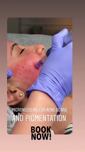 Microneedling❤️#massage #headmassage #tiktok #acneskin #ancetreatment #cologen