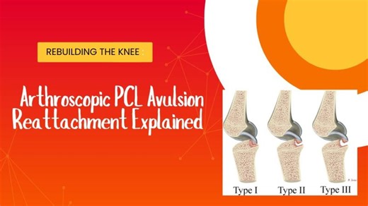 Rebuilding the Knee: Arthroscopic PCL Avulsion Reattachment Explained | Sharath K Ramanath