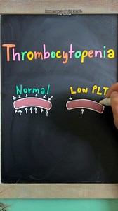 🩸 THROMBOCYTOPENIA Review for Nursing Students follow @nursewellversed for visual nursing education Thrombocytopenia is a condition where the patient has an abnormally low platelet count in the blood, which increases the risk of bleeding. ✅Normal Platelet Range: 150,000-450,000 ➡️ Platelets are formed in the bone marrow, and about 1/3 are stored in the spleen. 🩸 Platelets help with blood clotting to stop bleeding Causes: → Impaired Platelet Production: viral infections (HIV, hepatitis), folate