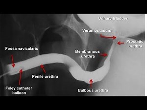 Retrograde Urethrogram / Ascending urethrography