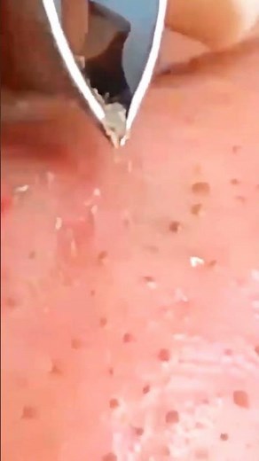 Extreme Pimple Popping Compilation 2025 😱 | Most Satisfying Video Ever