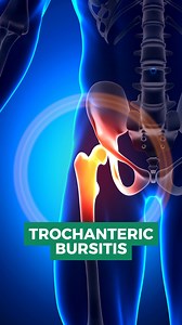 Trochanteric Bursitis is the inflammation of the trochanteric bursa, a fluid-filled sac located on the outer side of the hip, near the greater trochanter of the femur. This condition is a common cause of hip pain, particularly in adults, and is often associated with overuse, trauma, or underlying conditions like arthritis. Verdun Main Street, Nour EL Hayat Building, Near ABC verdun, 11th Floor ☎️76/866885 - 01/866885 📱 96170414912 #radiofrequency #verdun #pain_management #disc #herniated_disc #