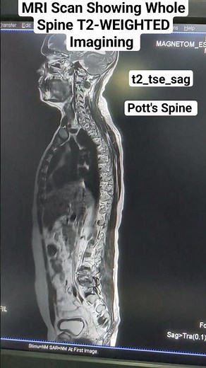 MRI Whole Spine Sagittal Section Showing Pott's Spine t2_tse_sag #beginners