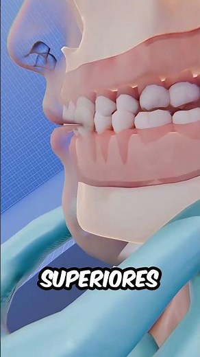 Cómo los Cirujanos Corrijen la Mordida Inferior: Cirugía de Mandíbula Paso a Paso #shorts