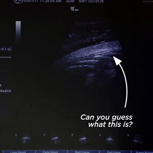 Did you know? Veterinarians cannot confirm a killer whale is pregnant until about 6 months into the pregnancy. At first, because the whale is positioned on her side during the ultrasound, and the fetus is so small it will fall below the scope of the ultrasound which can only read up to about 30CM, veterinarians will only be able to see the amniotic fluid. As the pregnancy continues and the fetus grows it will eventually get so big that it’s impossible to see the entire fetus in one image. Can yo