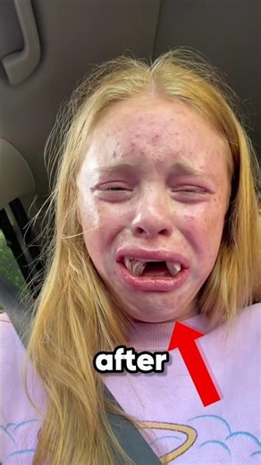 People Go Totally Crazy After Wisdom Teeth #WisdomTeeth #Anesthesia #DentalSurgery