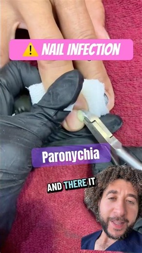 Painful Nail Infection? Here’s What a Paronychia Looks Like