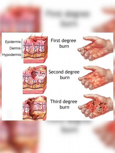 BURN🔥 Very Important and Simple Notes | Degree of Burn , Causes Classification, Short Notes!!