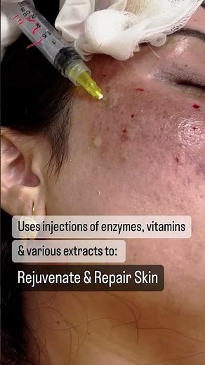 Mesotherapy for Skin Repair