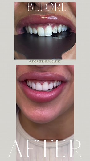 Composite Bonding on 4 Teeth: Watch the Process!