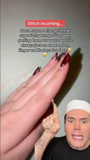 HOW TO GET RID OF PIMPLES ON YOUR FINGER!😱 #eczema #skincaretips #skincarereview #skincareproducts
