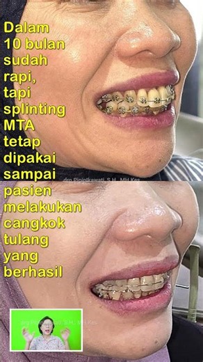 CASE OF ALL TEETH LOOSE WITH SEVERE BONE DAMAGE || PART 3 OF 5