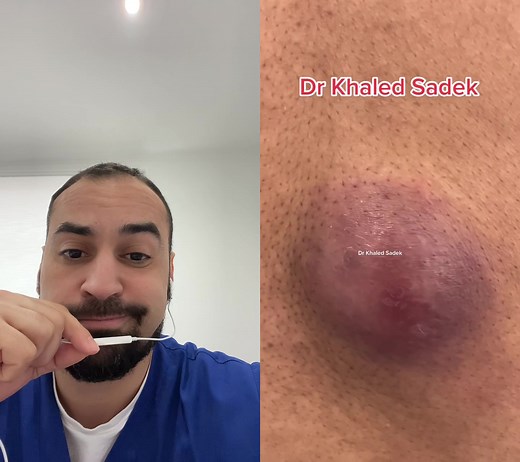 Infected Abscess Removal: Understanding Epidermoid Cysts