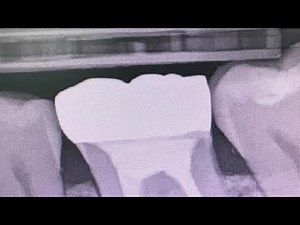 Review of Eighteeth Nanopix Digital X-ray Sensor